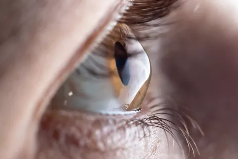 Photo of eye with keratoconus