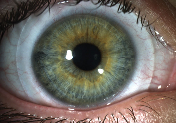 Mini-scleral lens in eye