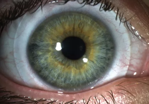 Mini-scleral lens in eye
