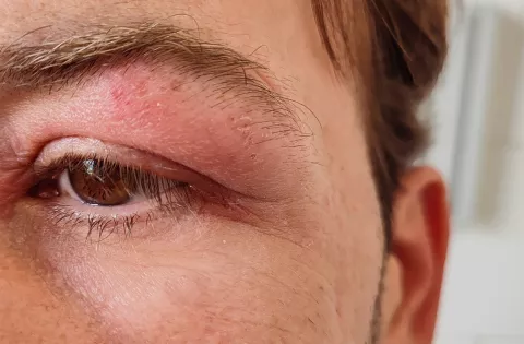 red, swollen eye lid