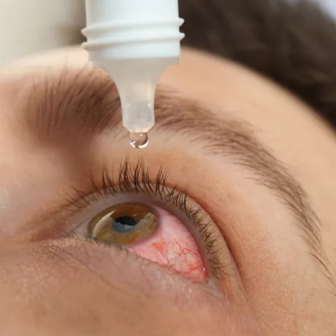 Person with red, irritated eye self-administering eye drops